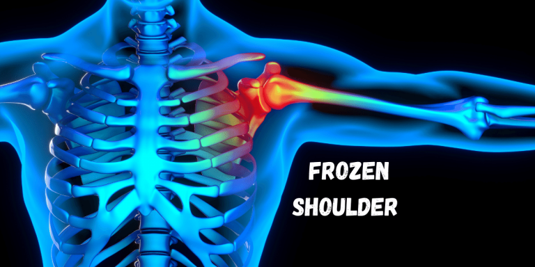 Frozen Shoulder